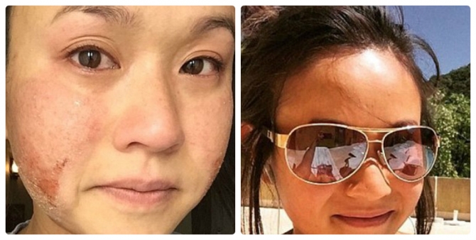 Thiếu nữ bị bong tróc da khắp người sau khi nâng ngực - 6