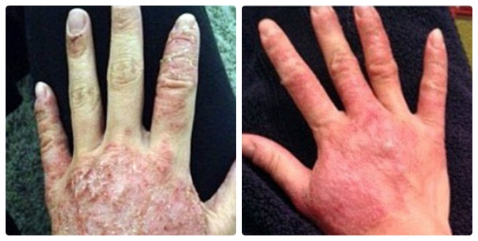 Thiếu nữ bị bong tróc da khắp người sau khi nâng ngực - 4