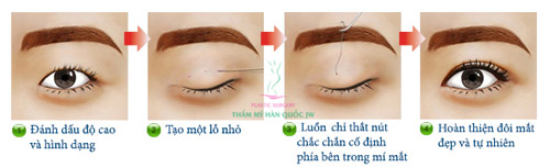 Kỹ thuật mới nhấn mí vĩnh viễn tại JW - 2