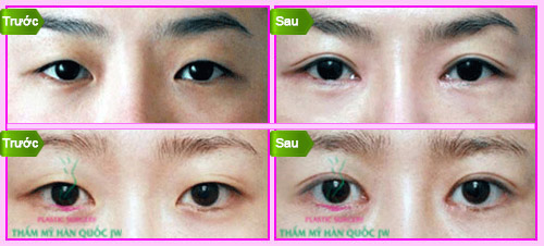 Kỹ thuật mới nhấn mí vĩnh viễn tại JW - 3