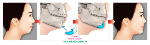 Giải pháp hiệu quả cho chiếc cằm ngắn kém duyên - 5
