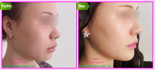 Giải pháp hiệu quả cho chiếc cằm ngắn kém duyên - 7