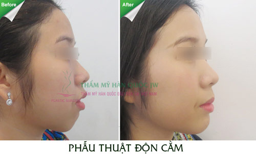 Giải pháp hiệu quả cho chiếc cằm ngắn kém duyên - 8