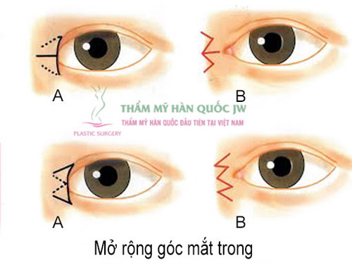 Phẫu thuật mắt to và những điều chưa biết - 4