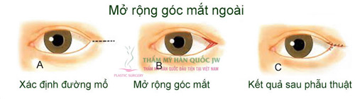 Phẫu thuật mắt to và những điều chưa biết - 5