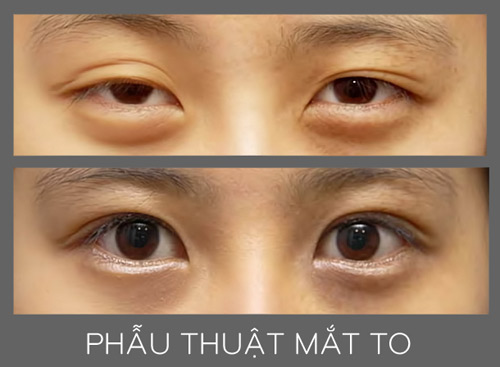 Phẫu thuật mắt to và những điều chưa biết - 8