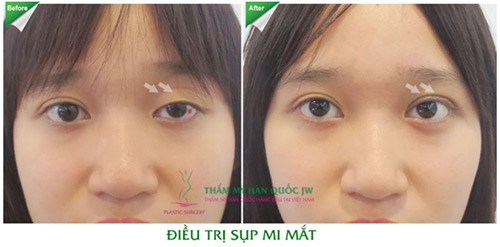 Phẫu thuật mắt to và những điều chưa biết - 9