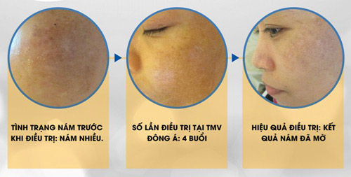 Chia sẻ cách tái tạo da sau 10 năm mắc nám - 4