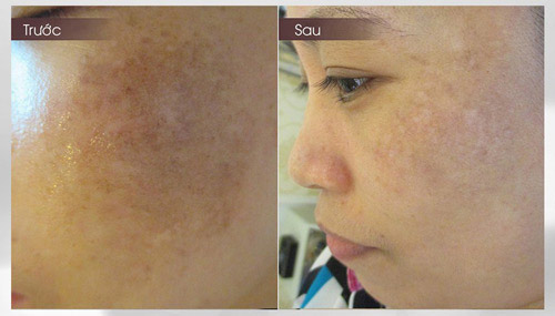 Chia sẻ cách tái tạo da sau 10 năm mắc nám - 5