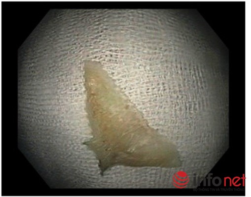 Suýt tử vong vì xương cá ngát làm thủng thực quản - 2