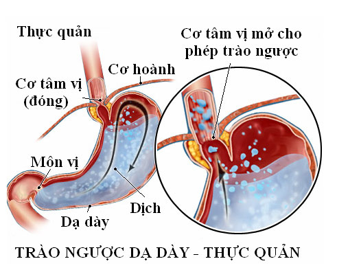 Dấu hiệu nhận biết bệnh trào ngược dạ dày thực quản - 1