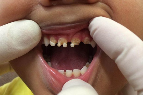 Rùng mình hàm răng của trẻ nghiện nước ngọt có ga - 1