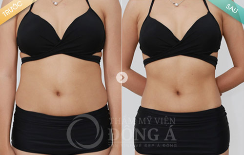 Bụng thừa mỡ sau sinh chỉ là chuyện vặt! - 5