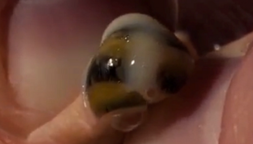 Ghê rợn ốc sên biển sống trong đầu gối bé trai 4 tuổi - 1