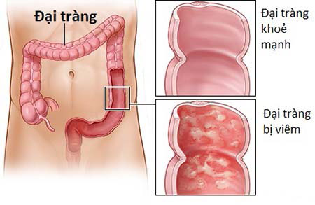 Cách chữa viêm đại tràng mới nhất - 1