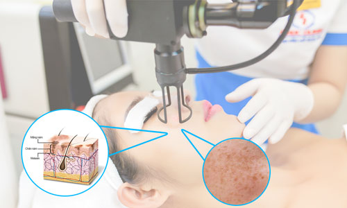 Giải pháp trị nám toàn diện không xâm lấn - 1
