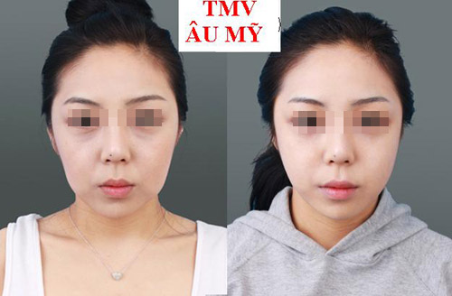 Cách khắc phục triệt để cơ mặt chảy xệ - 3