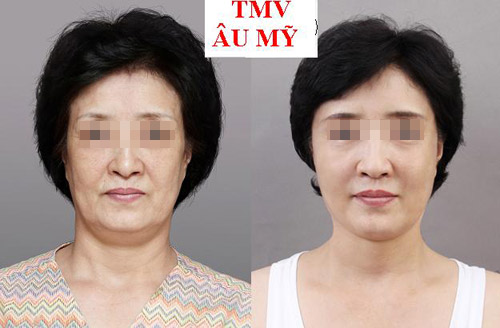 Cách khắc phục triệt để cơ mặt chảy xệ - 4