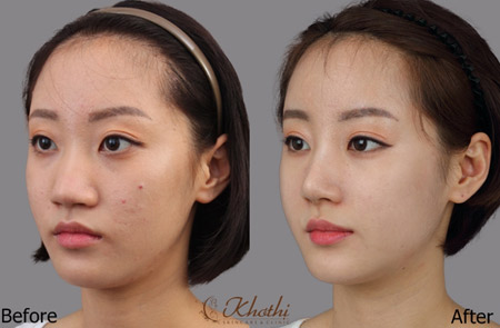 Khơ Thị trợ giá: Ưu đãi 40% nâng mũi Hàn Quốc - 2