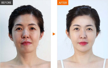 Khơ Thị trợ giá: Ưu đãi 40% nâng mũi Hàn Quốc - 3