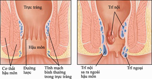 Bệnh trĩ sau phẫu thuật cần lưu ý gì? - 1