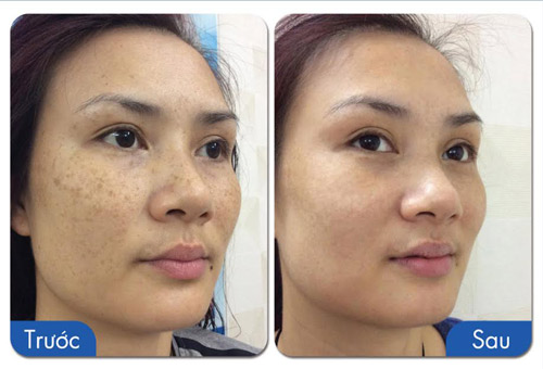 Hoa khôi bóng chuyền Kim Huệ tìm lại làn da không tuổi - 5