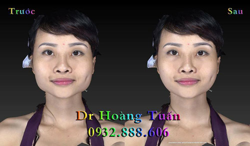 Cô gái xấu xí Chipy Polla khoe làm đẹp từ phép màu thẩm mỹ - 4