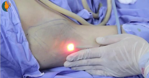 Làm sao để khử mùi hôi nách sau 1 lần? - 2