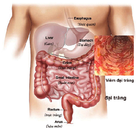 Bật mí cách chữa viêm đại tràng cấp và mạn tính - 1