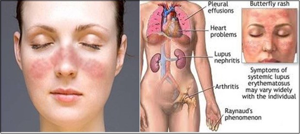Lupus ban đỏ: Bệnh hiểm gây tổn thương tất cả các cơ quan trong cơ thể - 1