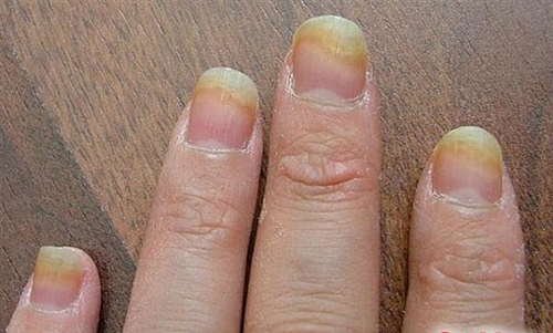 5 bí quyết tẩy sạch nấm và làm trắng móng tay - 2