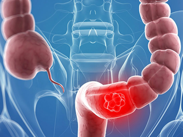 Thoát viêm đại tràng nhờ cách chữa đơn giản - 1