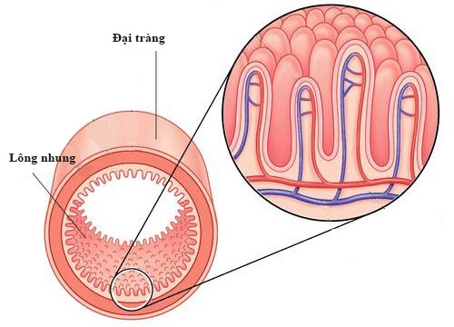 Thoát viêm đại tràng nhờ cách chữa đơn giản - 2