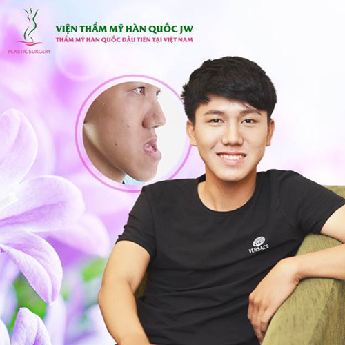 700 ca phẫu thuật hô móm và lời khuyên từ chuyên gia - 3