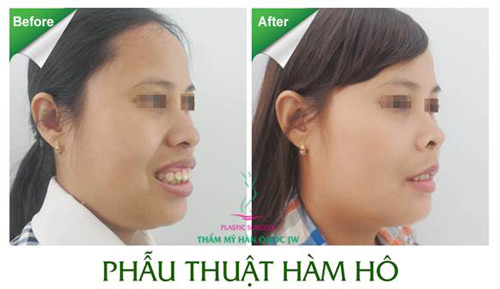 700 ca phẫu thuật hô móm và lời khuyên từ chuyên gia - 7
