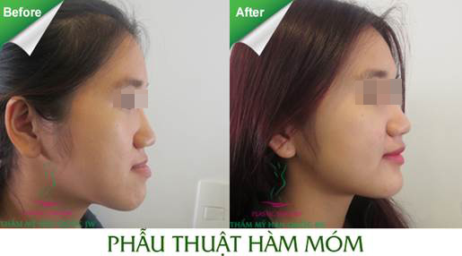 700 ca phẫu thuật hô móm và lời khuyên từ chuyên gia - 8