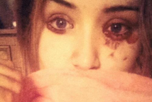 Kỳ lạ cô gái 16 tuổi chảy máu mắt 5 lần mỗi ngày - 1