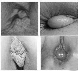 Những mối nguy hại luôn “rình rập” của bệnh trĩ - 2