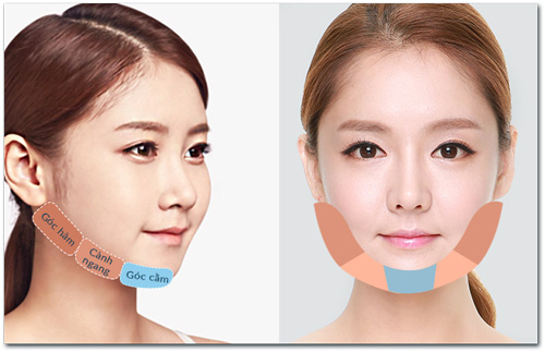 Gọt mặt V-line toàn diện - đẹp không góc "chết" - 2