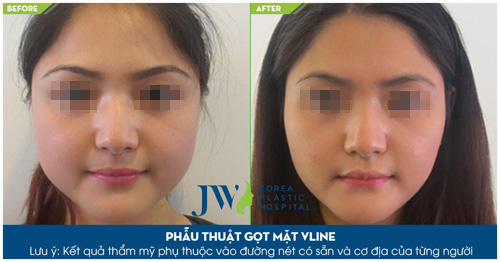 Gọt mặt V-line toàn diện - đẹp không góc "chết" - 3