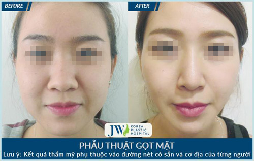 Gọt mặt V-line toàn diện - đẹp không góc "chết" - 5