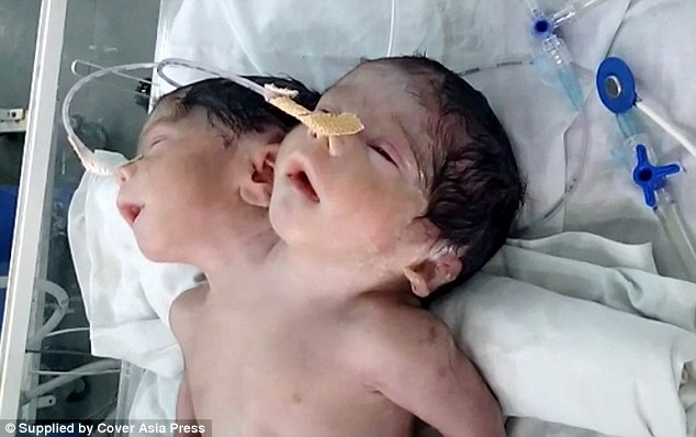 Em bé hai đầu chào đời ở Ấn Độ - 1