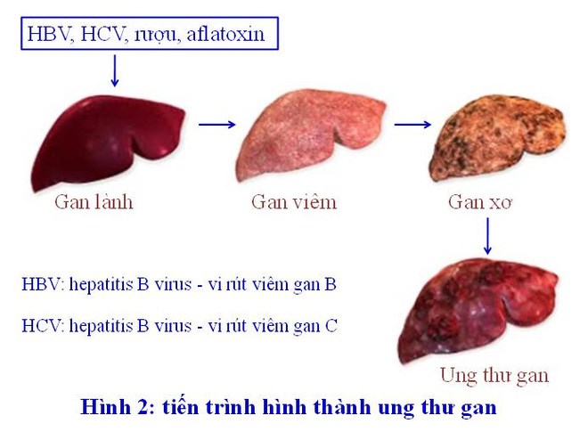 GS Nguyễn Chấn Hùng: Điểm mặt những bệnh ung thư đến từ virus, từ miệng - 1