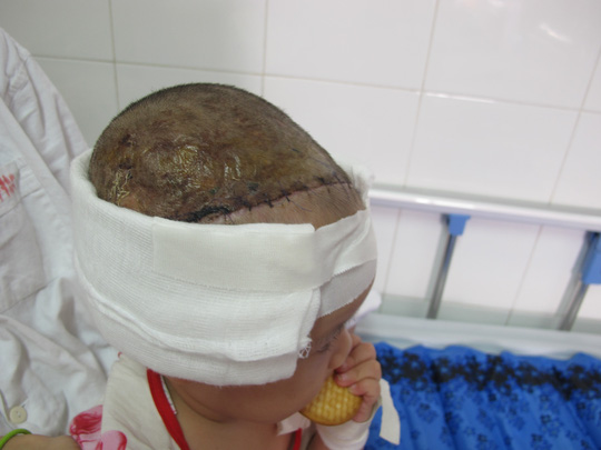 Bé 2 tuổi bị lột toàn bộ da đầu vì tai nạn giao thông - 2