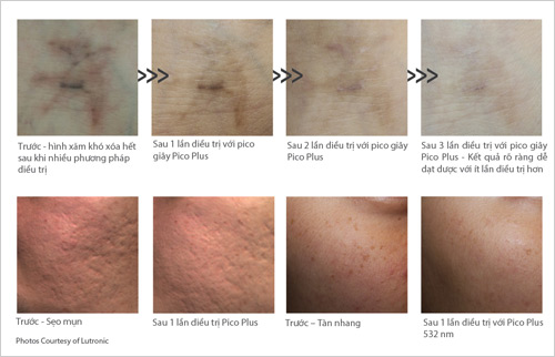 Pico Laser – Công nghệ đỉnh cao trong điều trị da thẩm mỹ và xóa xăm - 3