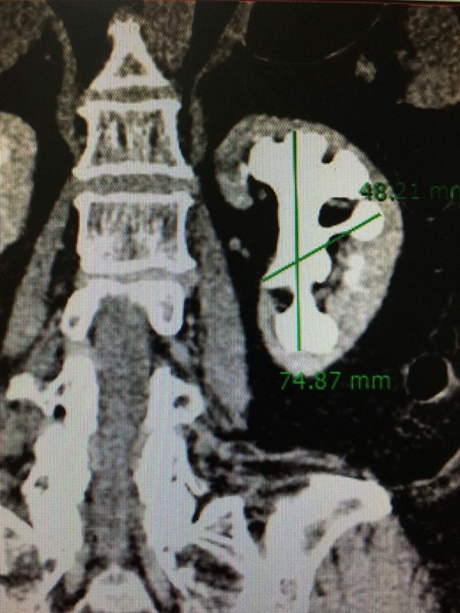 Bốn lần phẫu thuật để lấy viên sỏi thận san hô lớn nhất từ trước đến nay - 2