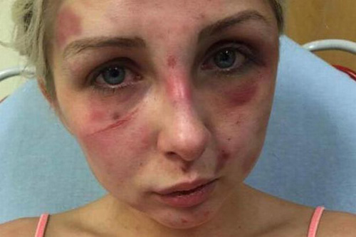 Cô gái bị đánh tím mặt vì phản đối bạn trai hút thuốc - 1