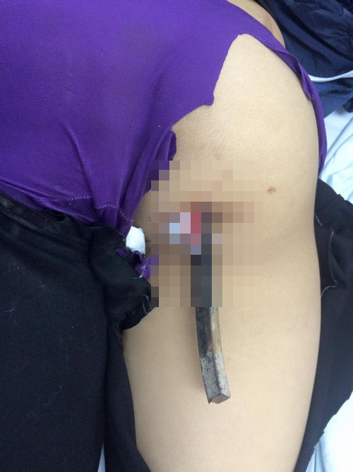 Nữ sinh bị thanh sắt trên xe ba bánh đâm xuyên người - 1