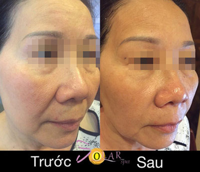 Giảm giá sốc 70% dịch vụ nâng cơ mặt, trẻ hóa da trong 90 phút - 4