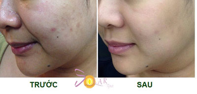 Giảm giá sốc 70% dịch vụ nâng cơ mặt, trẻ hóa da trong 90 phút - 5